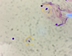 顕微鏡で検出されたマラセチア